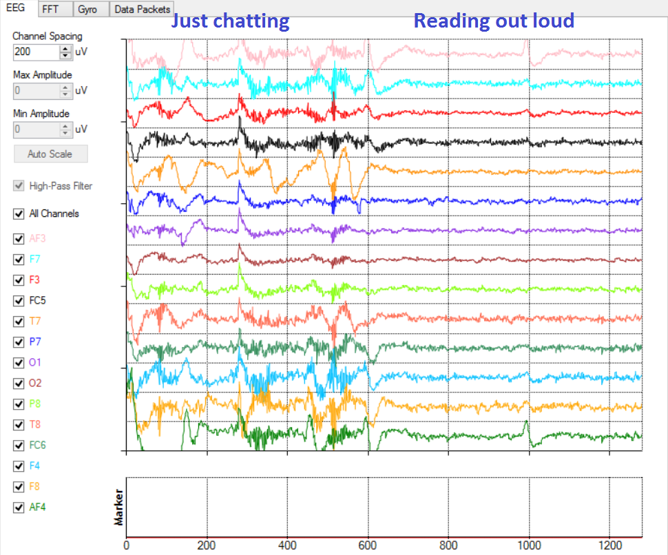 EEG trace of a Dyslexic